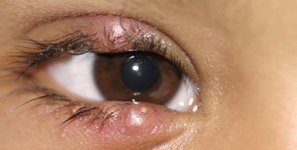 blefarite-site-oftalmo-clinica